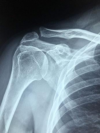 Types of Bone Fracture Injuries